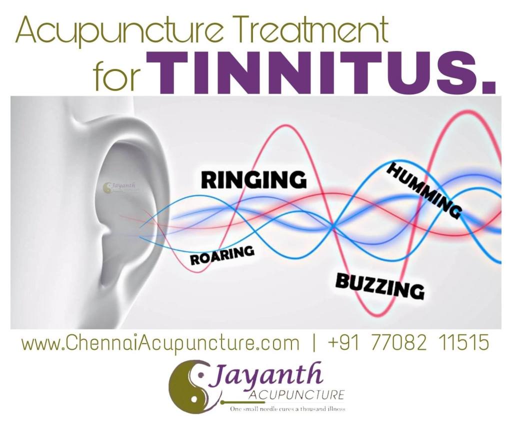 Acupuncture Treatment For Tinnitus in Chennai - Faster RecoveryBest Acupuncture Treatment by Well Experienced Acupuncture Doctor in Chennai